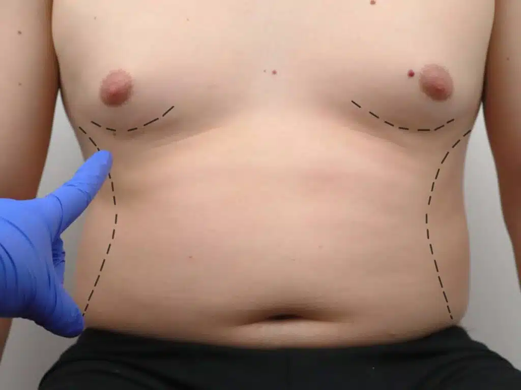 Business Opportunities: Partnering with Gynecomastia Specialists for Growth