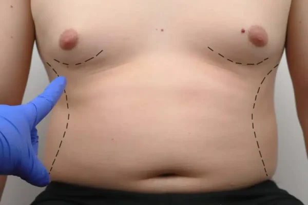 Business Opportunities: Partnering with Gynecomastia Specialists for Growth
